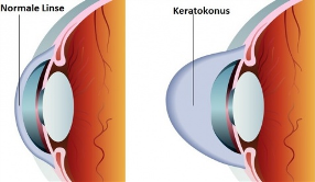 Keratokonus gesundpedia.de